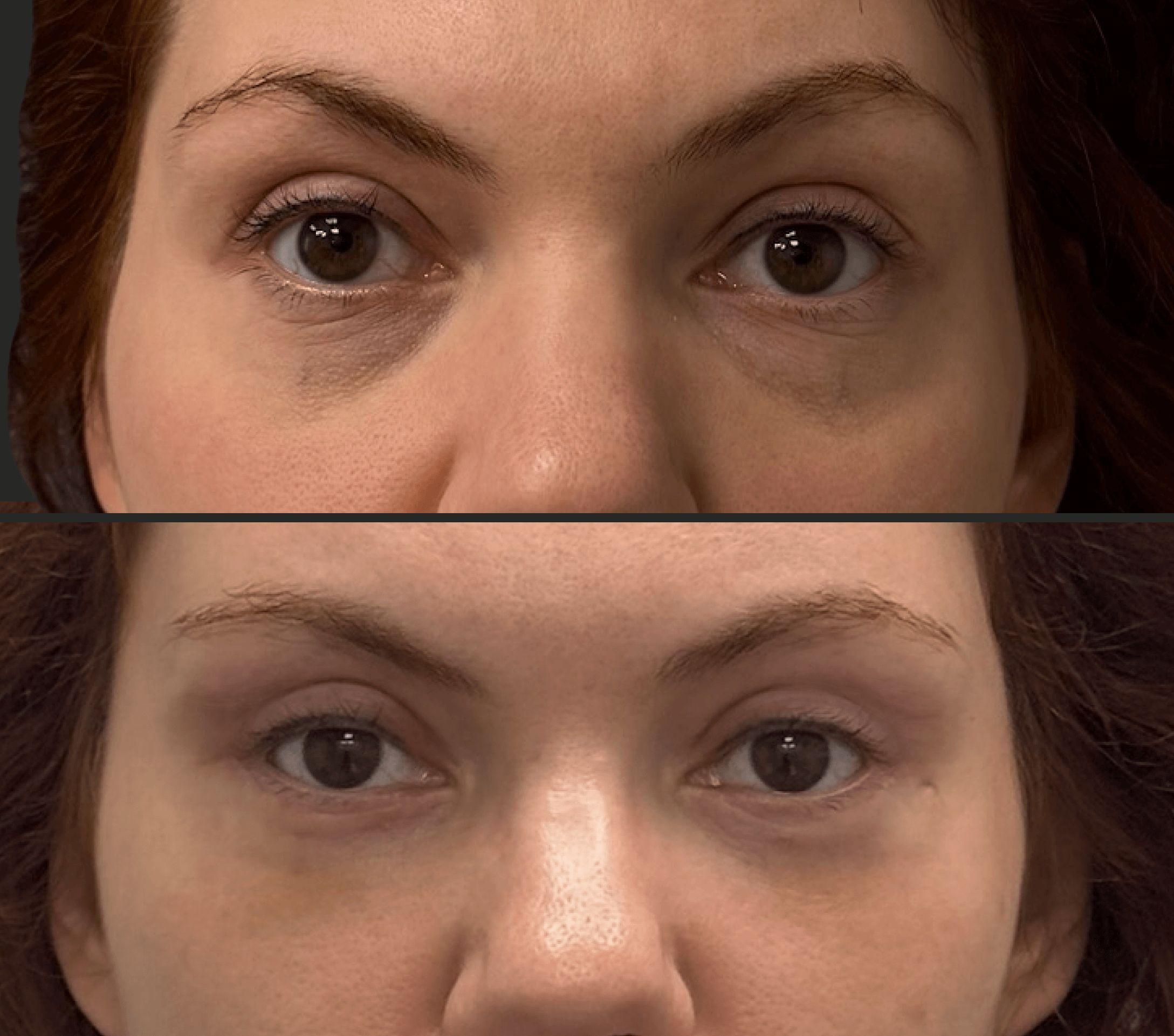 Нижняя блефаропластика 01