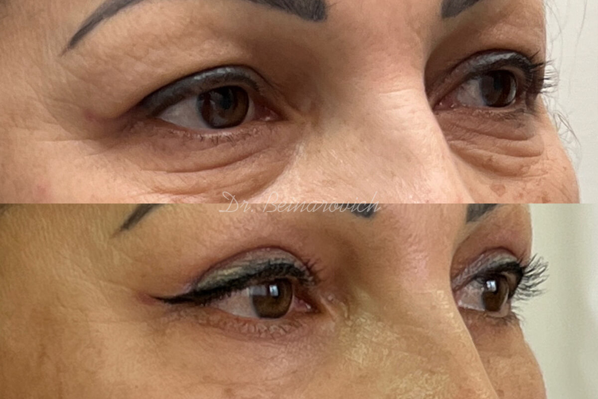 Нижняя блефаропластика 01