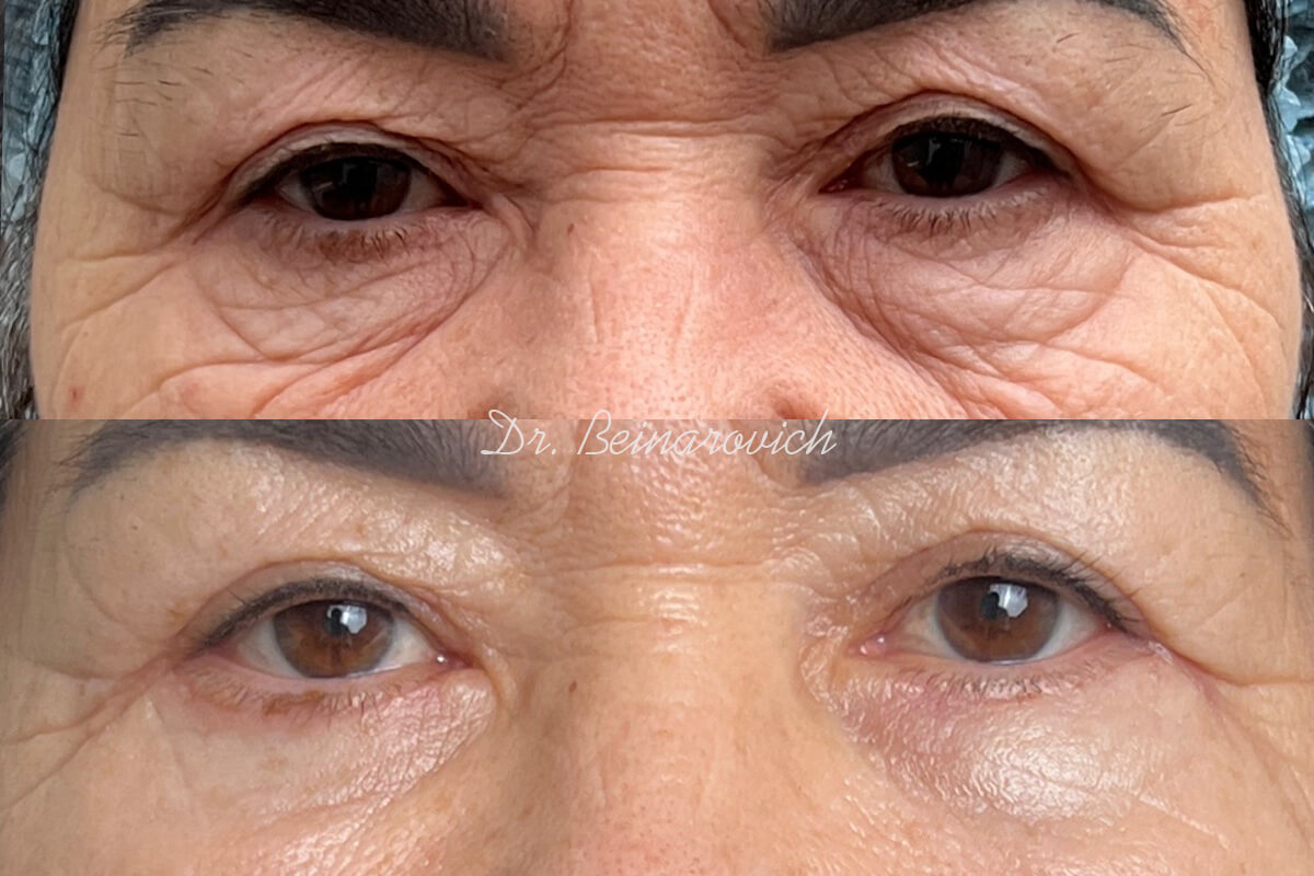 Нижняя блефаропластика 01