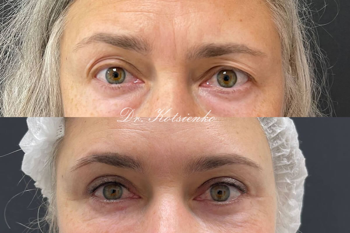 Нижняя блефаропластика 01