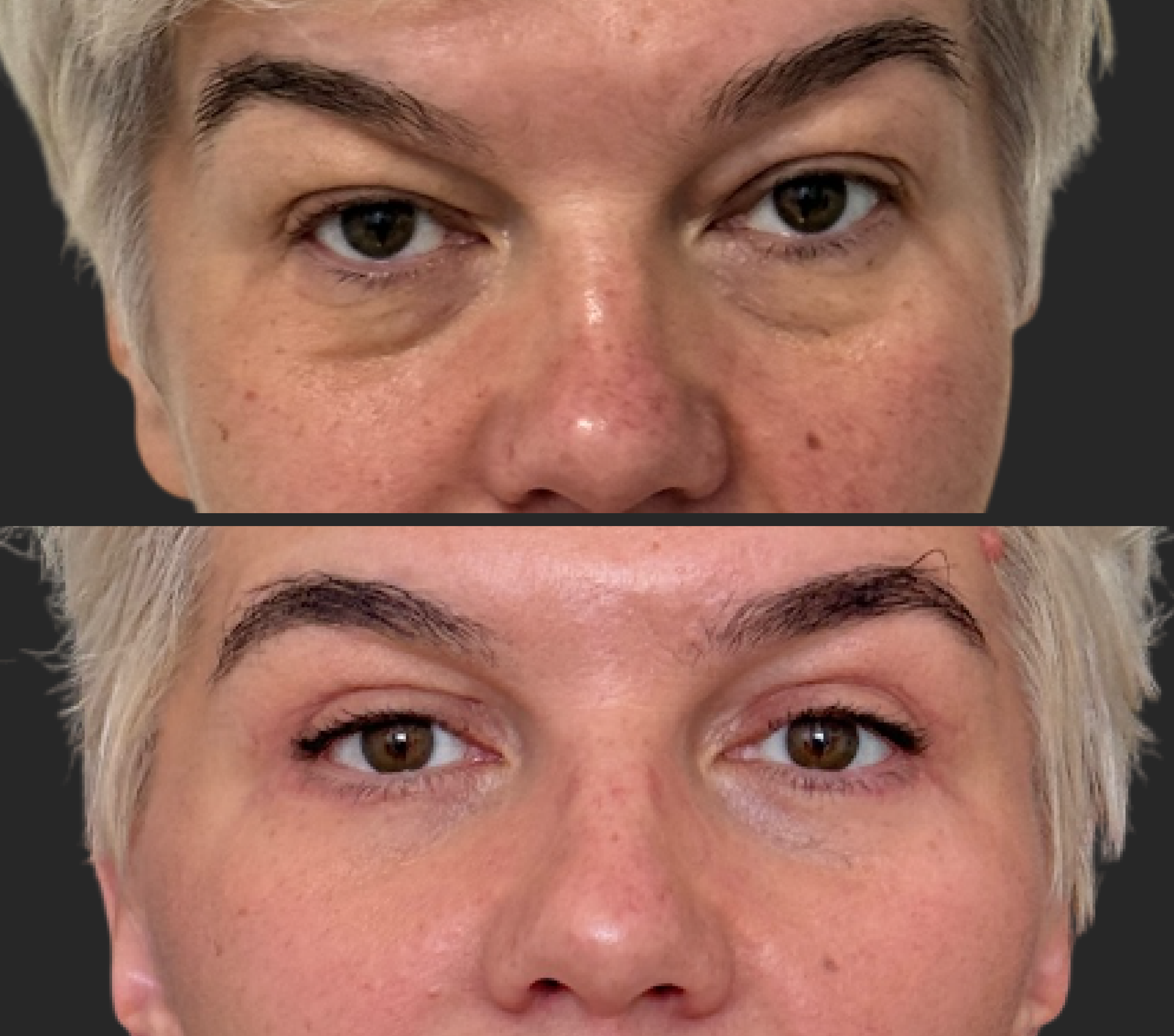 Нижняя блефаропластика 01