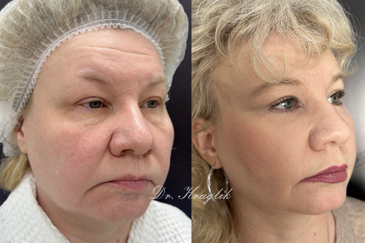 Нижняя блефаропластика 01