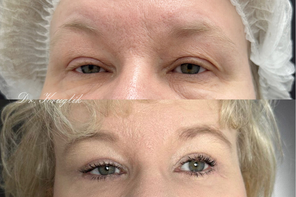 Нижняя блефаропластика 01