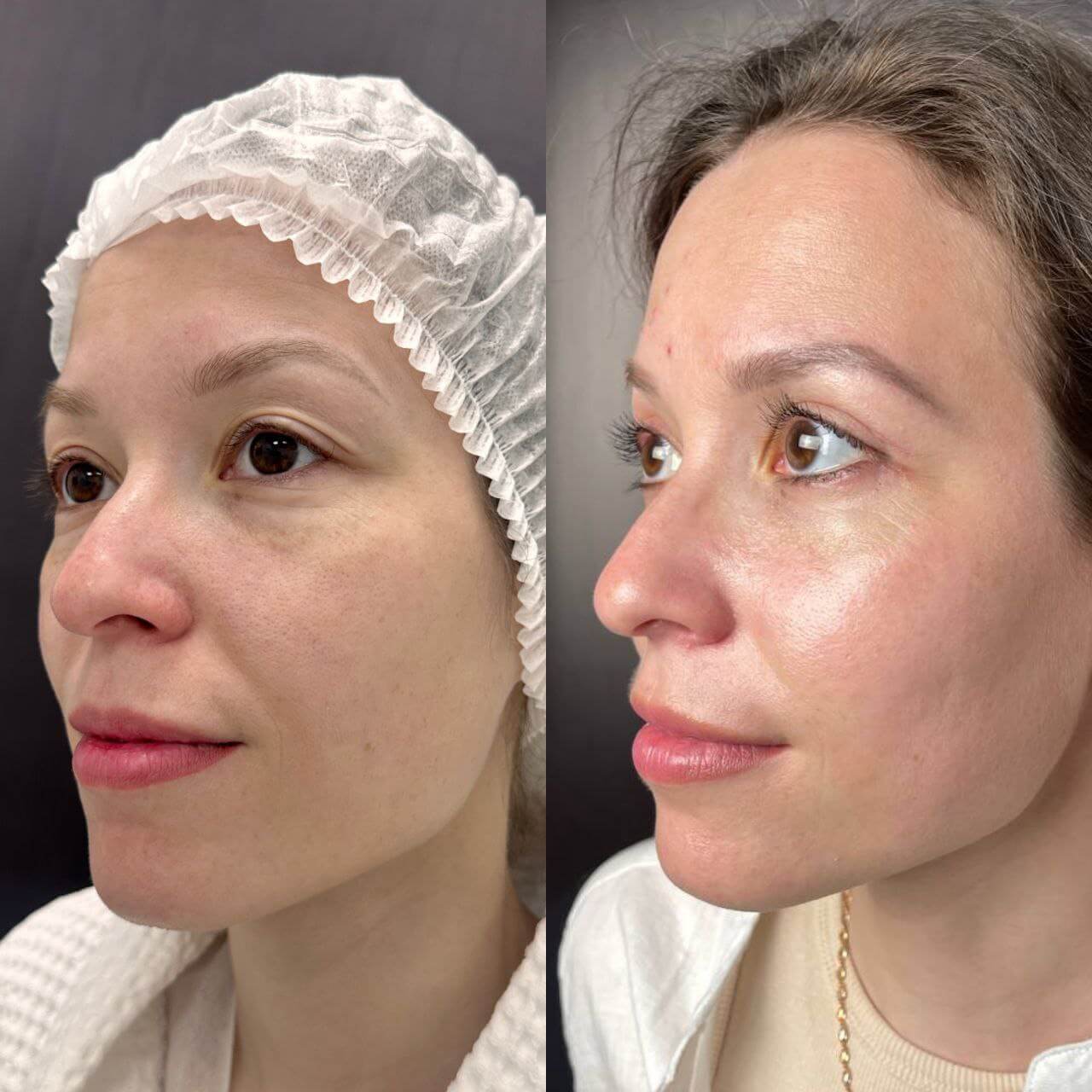 Нижняя блефаропластика 01