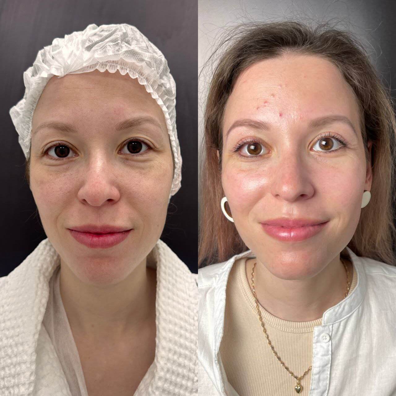 Нижняя блефаропластика 01