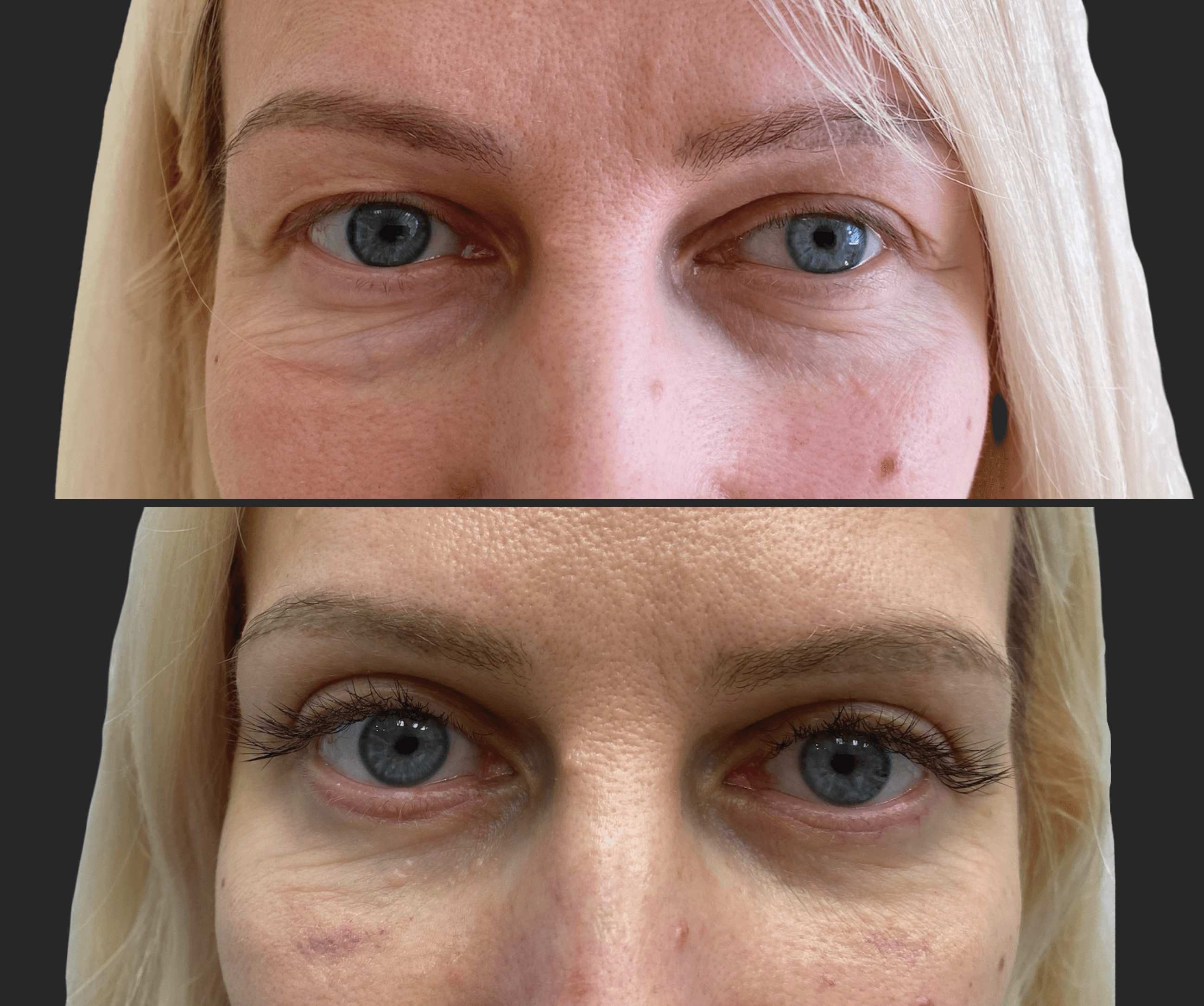 Нижняя блефаропластика 01