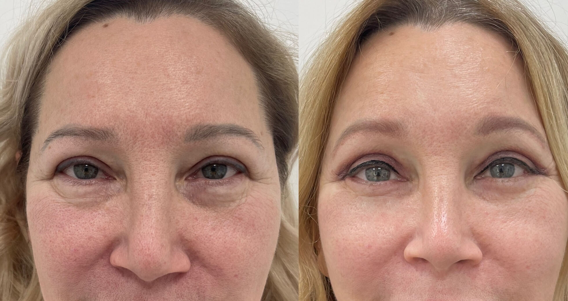 Нижняя блефаропластика 01