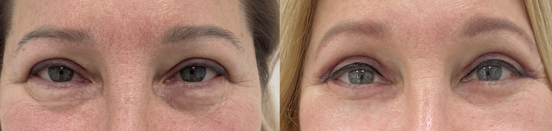 Нижняя блефаропластика 01