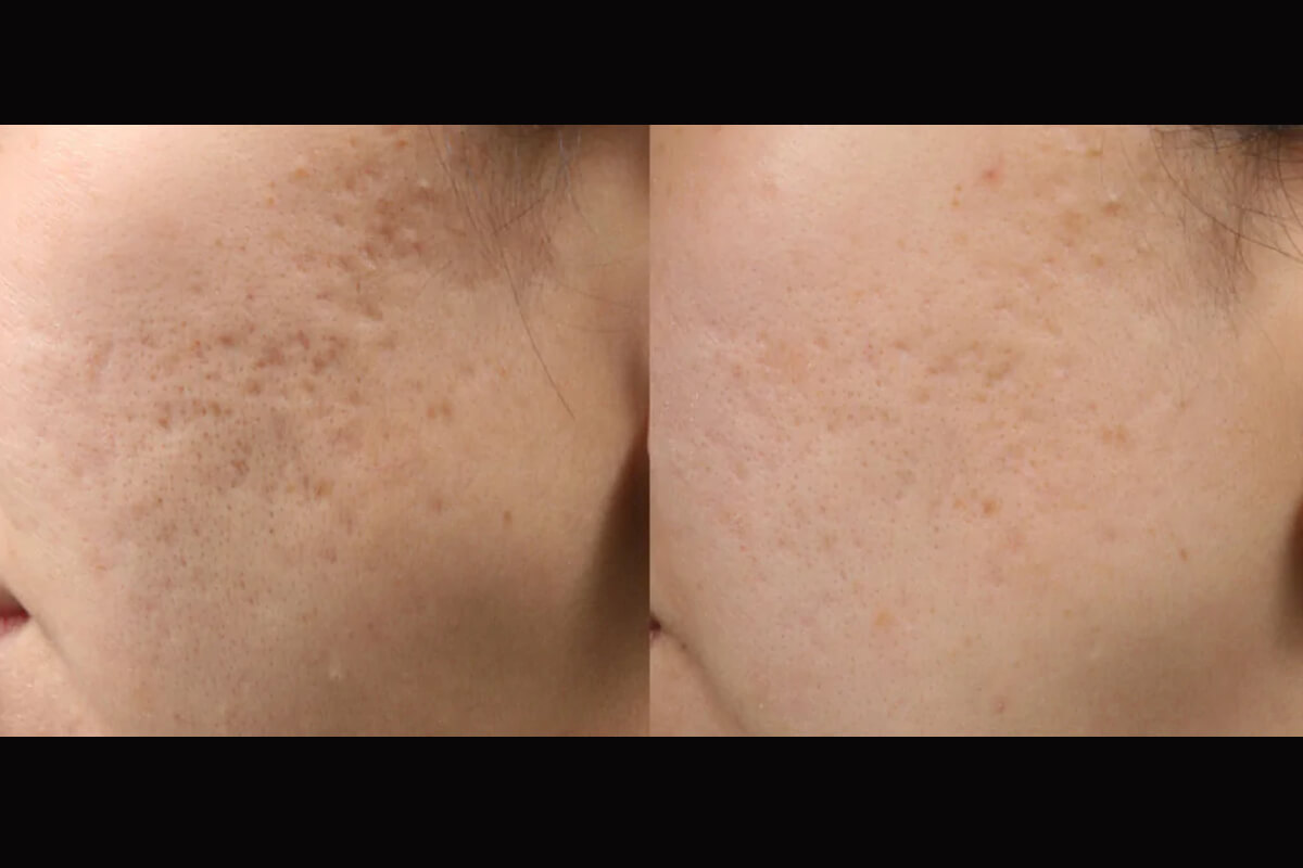 Микроигольчатый лифтинг POTENZA 01