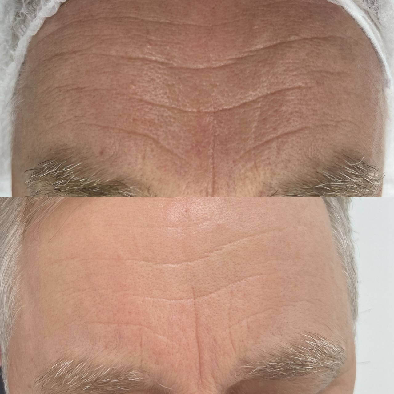 Микроигольчатый RF-лифтинг Morpheus 8 01