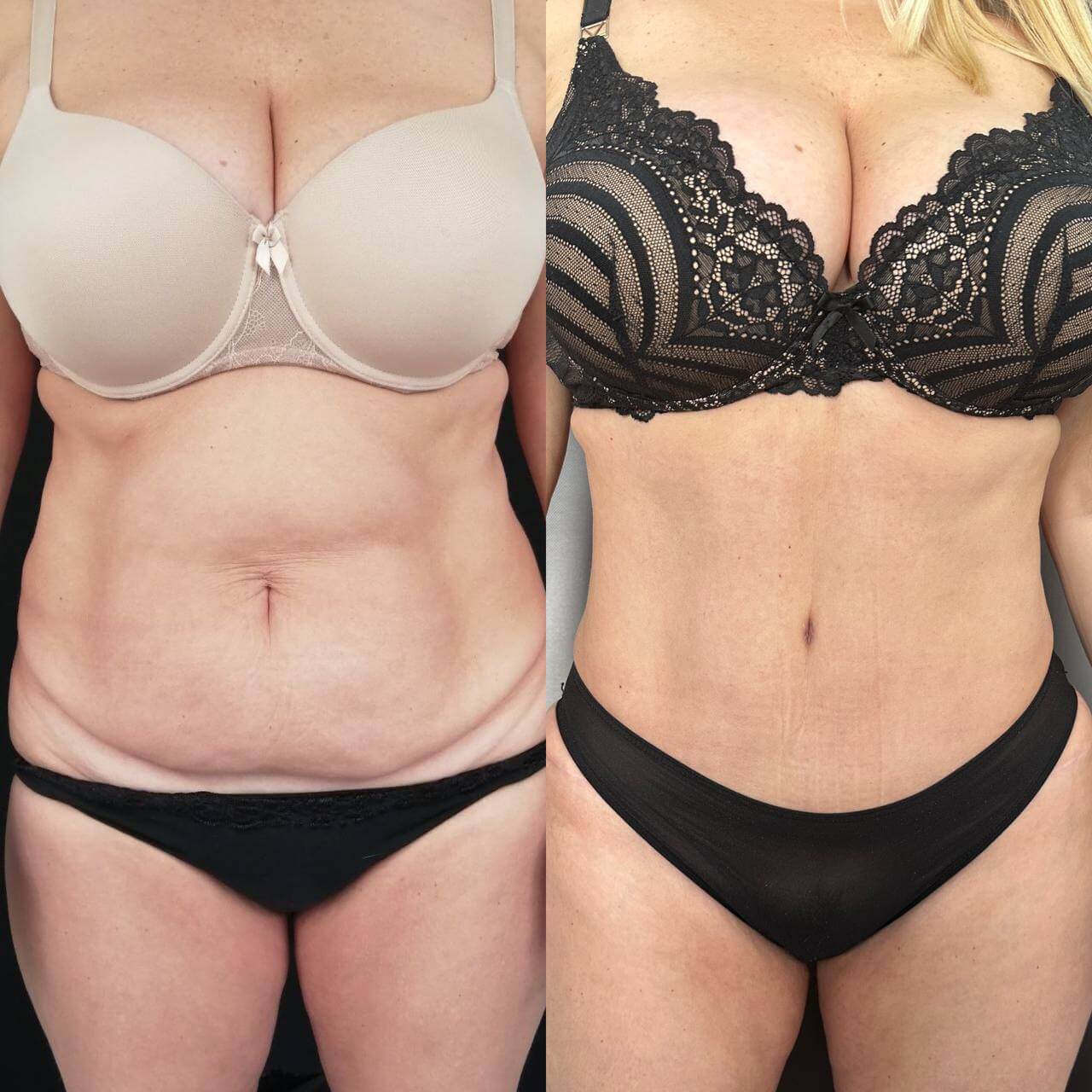 Абдоминопластика с липосакцией 01