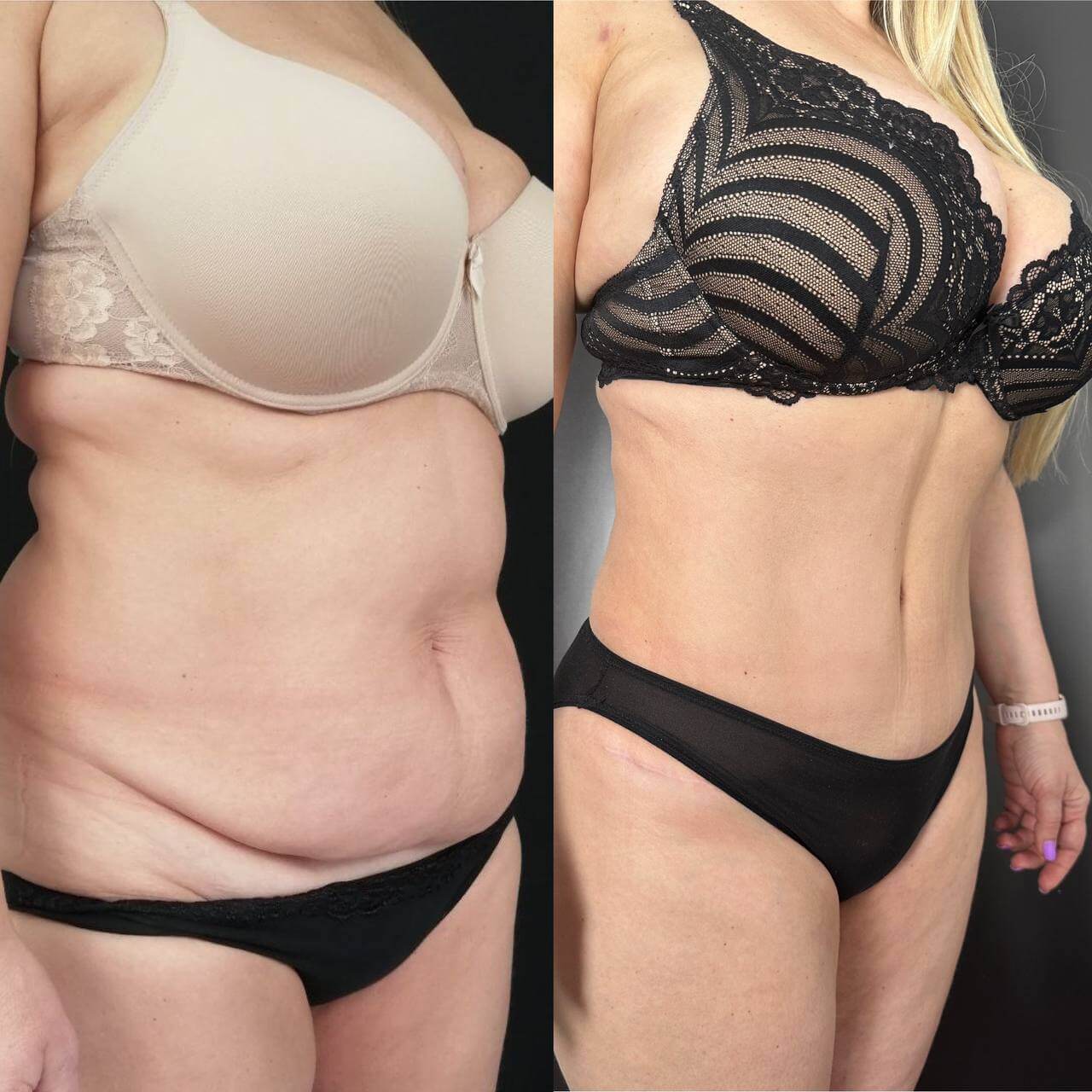 Абдоминопластика с липосакцией 01