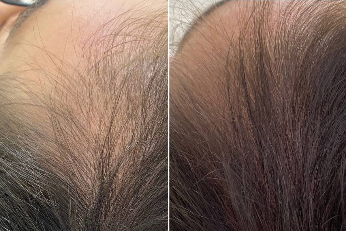 PRP-терапия 01