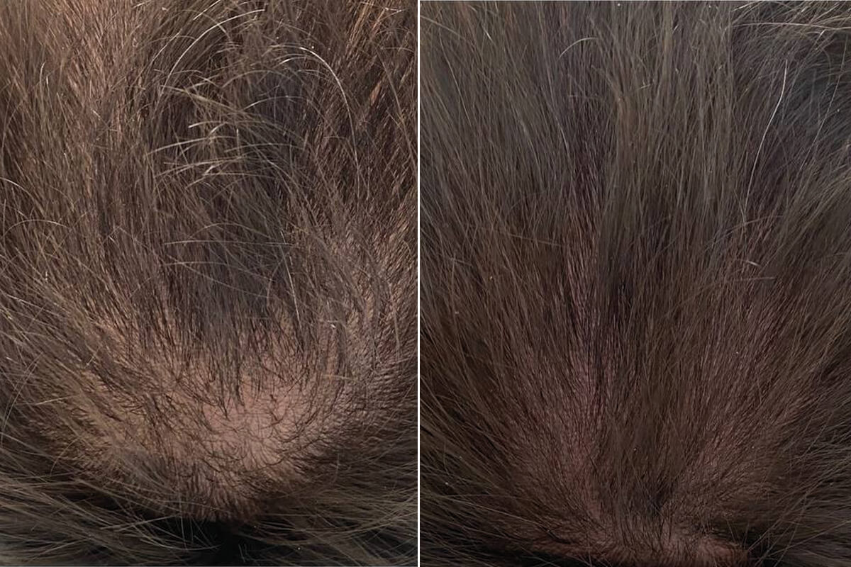 PRP-терапия 01