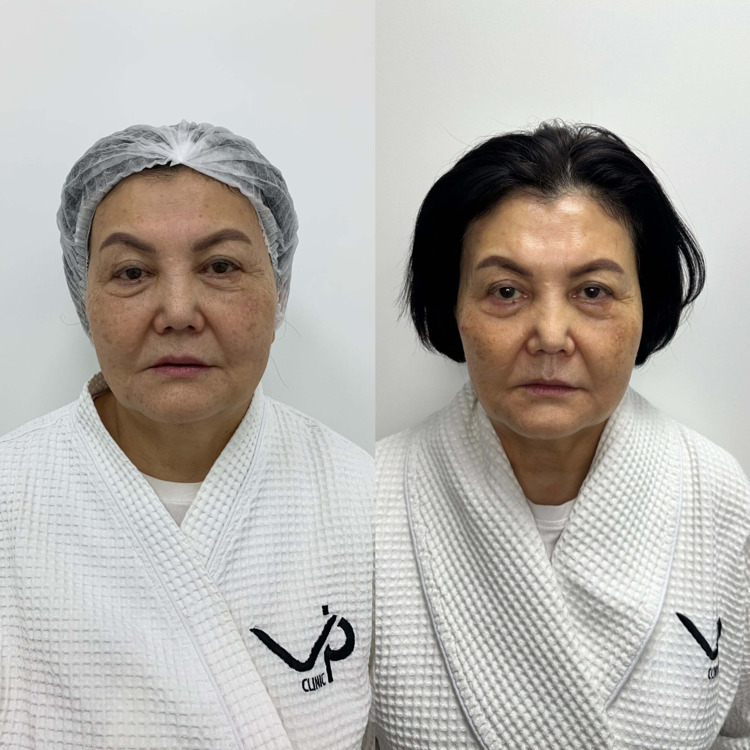 Ультраформер MPT 01