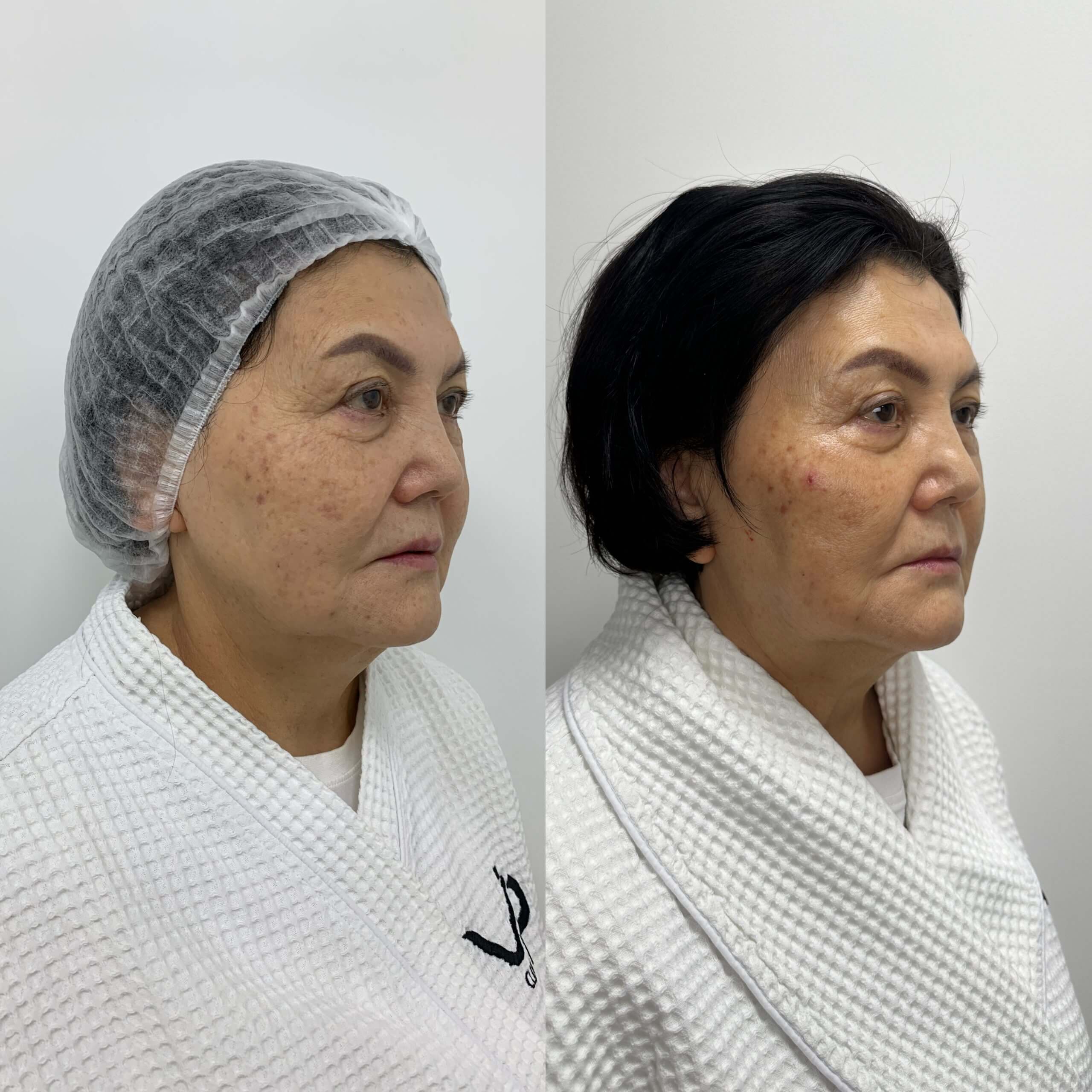 Ультраформер MPT 01