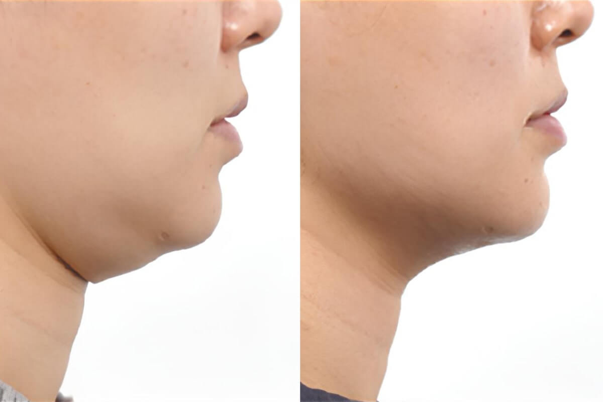 Ультраформер MPT 01