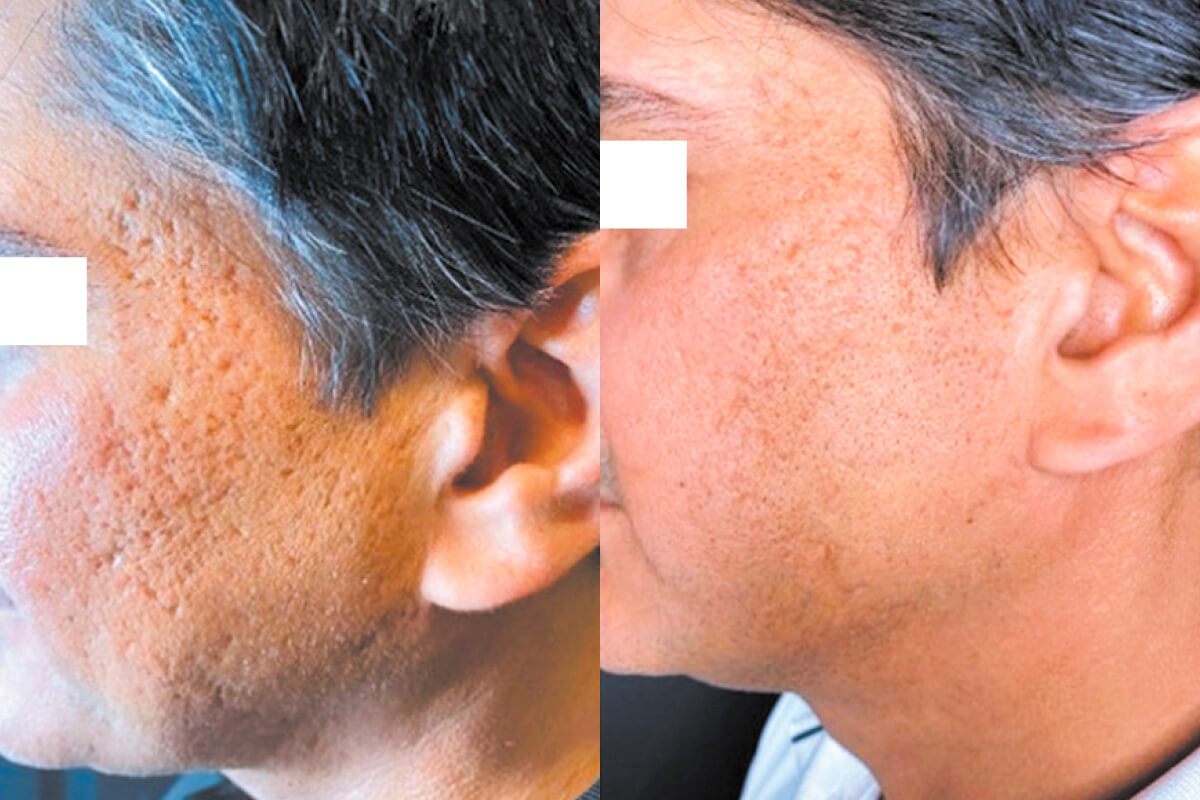 Микроигольчатый RF на аппарате Virtue RF 01