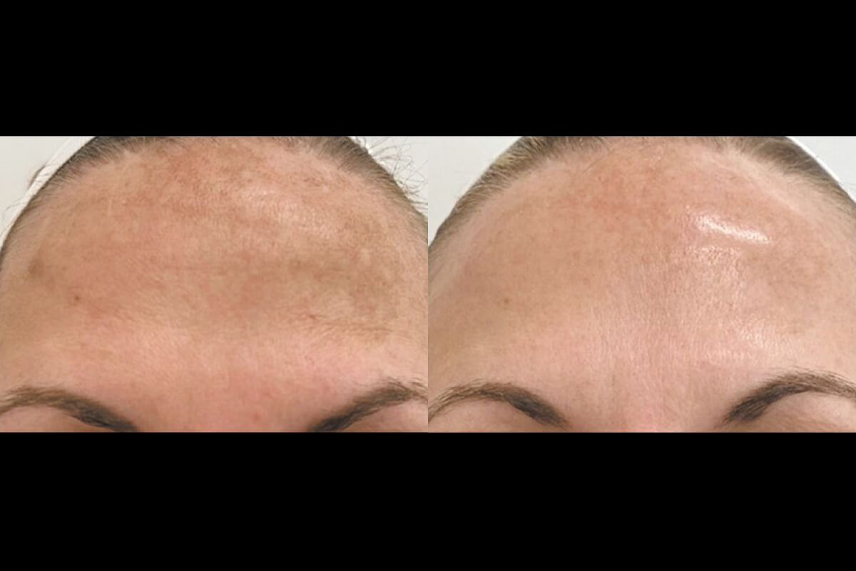 Микроигольчатый RF на аппарате Virtue RF 01