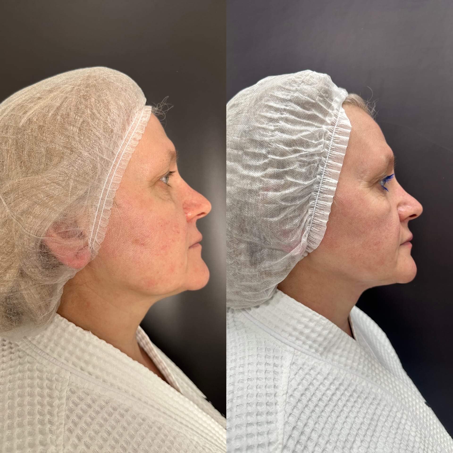 Микроигольчатый RF на аппарате Virtue RF 01