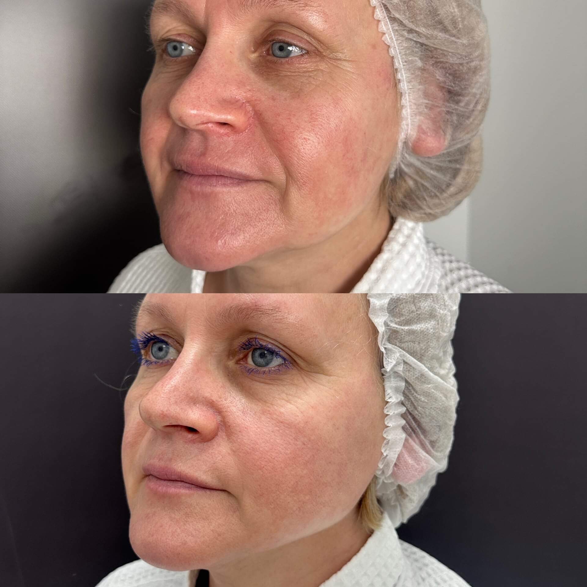 Микроигольчатый RF на аппарате Virtue RF 01