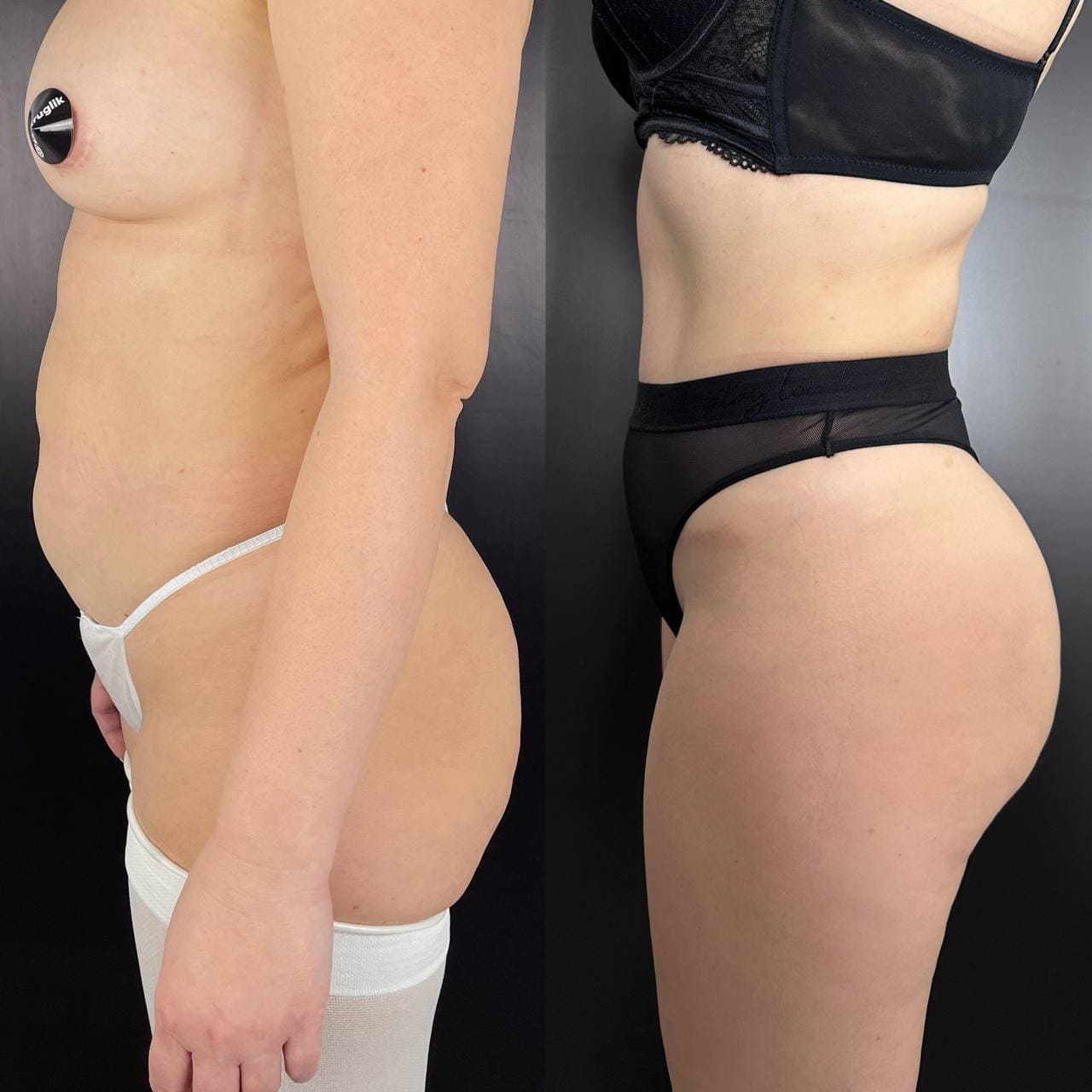 Липомоделирование тела 01