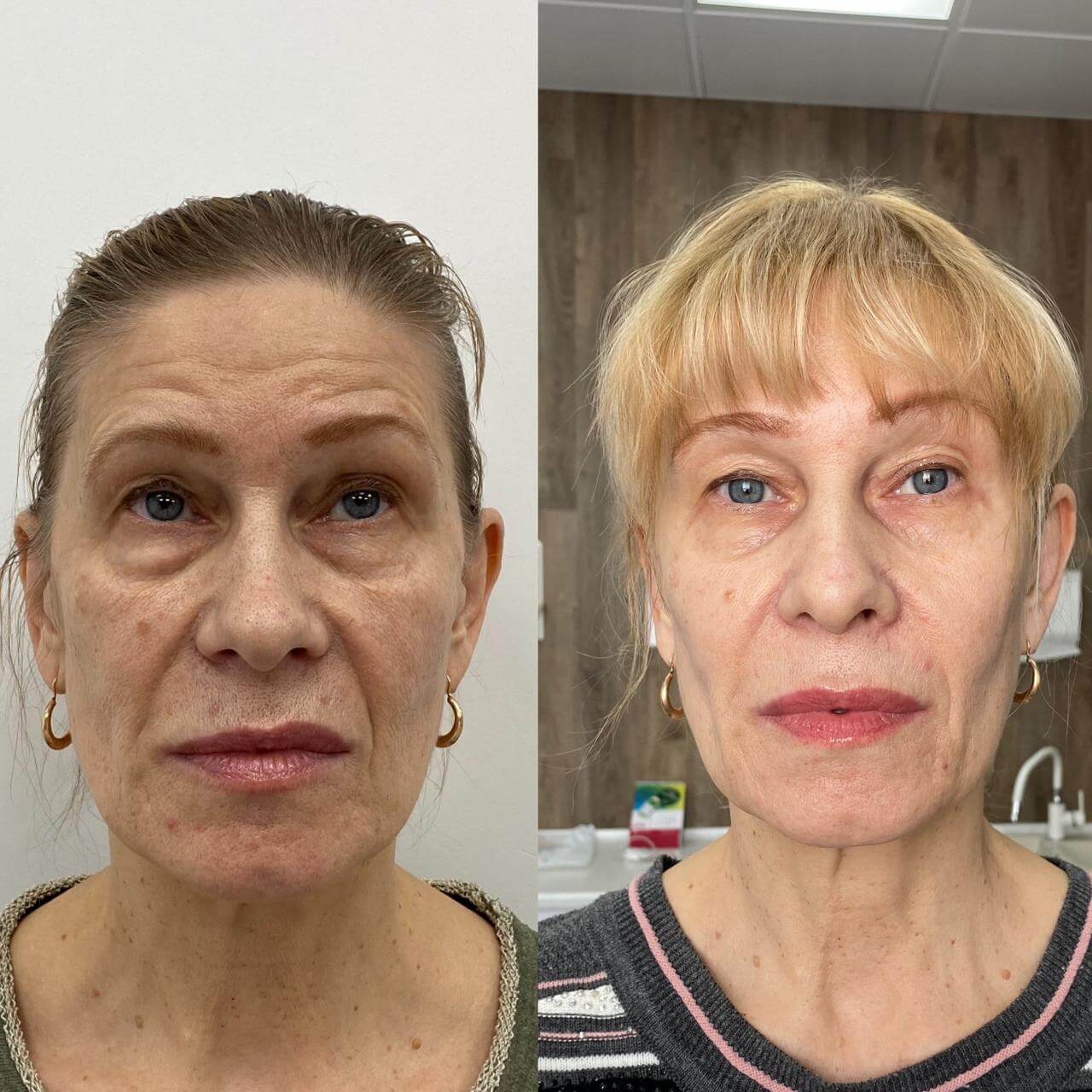 Ботулинотерапия 01