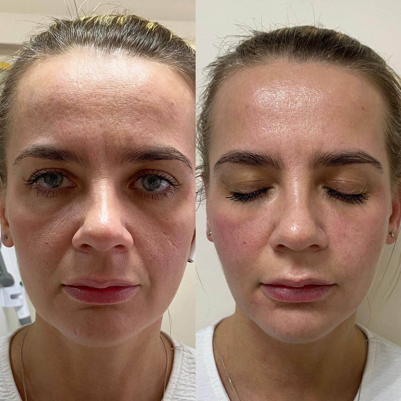 Ботулинотерапия 01