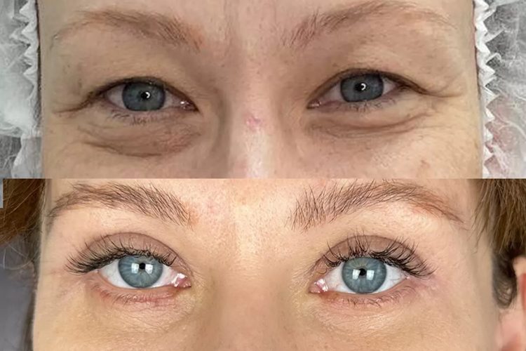 Операция по удалению грыжи нижнего века: избавление от мешков под глазами