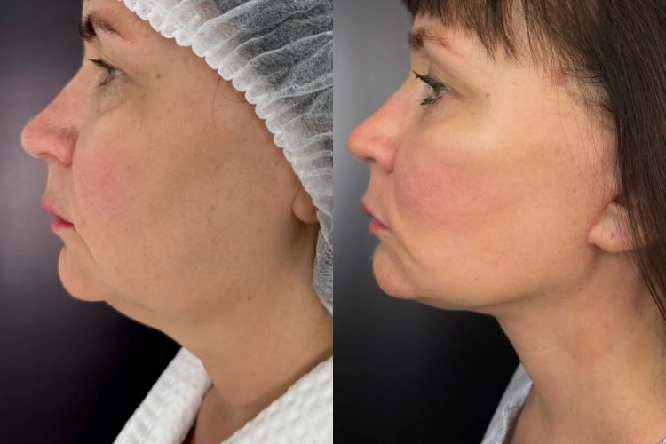 Как убрать морщины на шее: лучшие способы