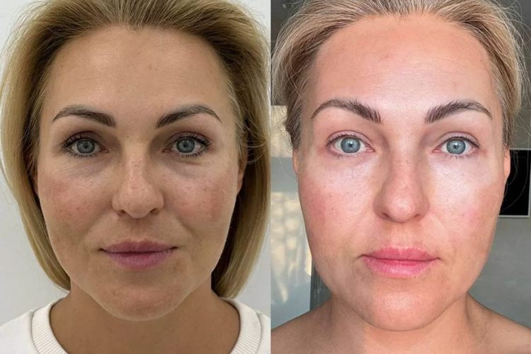 Самые эффективные процедуры для омоложения кожи лица